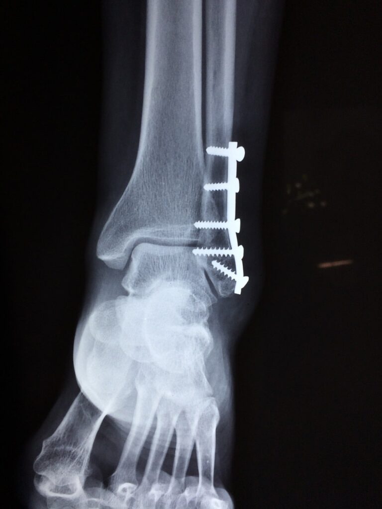 bota ortopedica